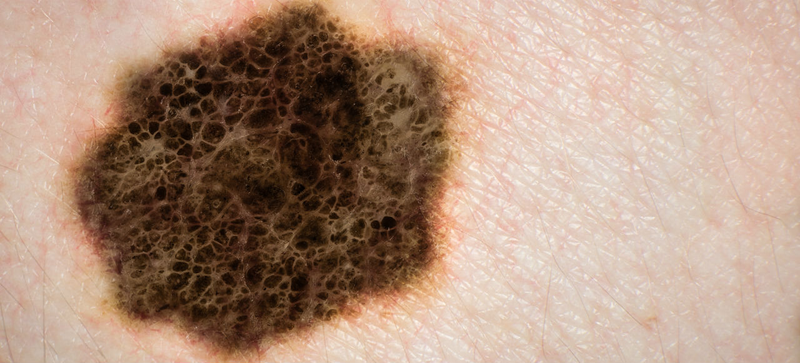 Illustration for article titled Finding, Treating, and Beating the Most Survivable Forms of Cancer
